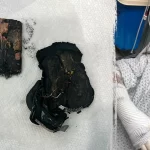 Portable charger explodes in bed, leaves woman with chemical burns