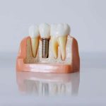 What Makes Dental Implants Feel More Natural