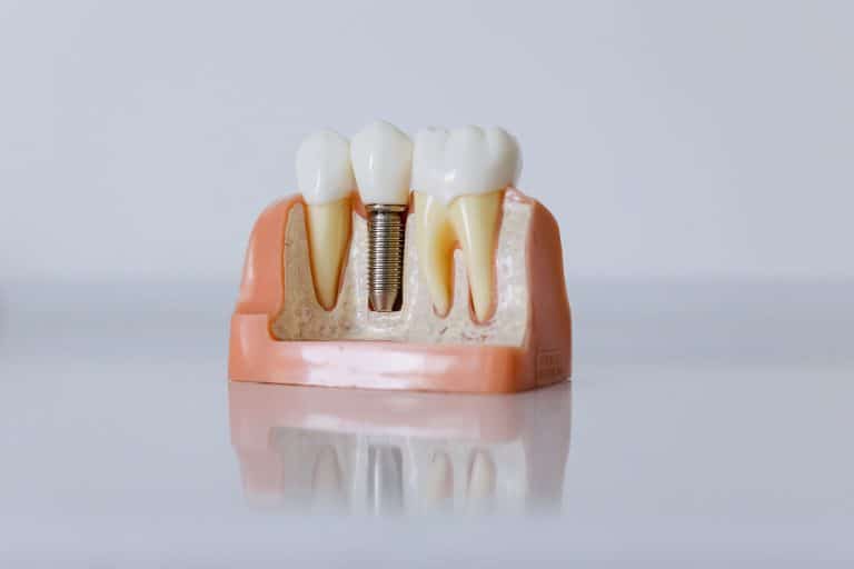 What Makes Dental Implants Feel More Natural